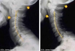 تجنب 5 أسباب تؤدي إلى حدوث آلام الرقبة