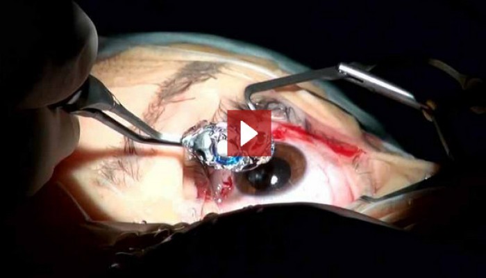 أول زراعة لتلسكوب مصغر في العين