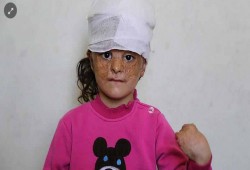 متطوعون أتراك يتكفلون بعلاج طفلة سورية مصابة بحروق بالغة