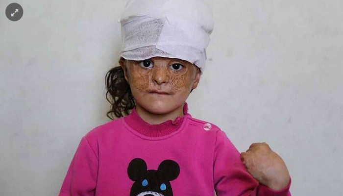 متطوعون أتراك يتكفلون بعلاج طفلة سورية مصابة بحروق بالغة