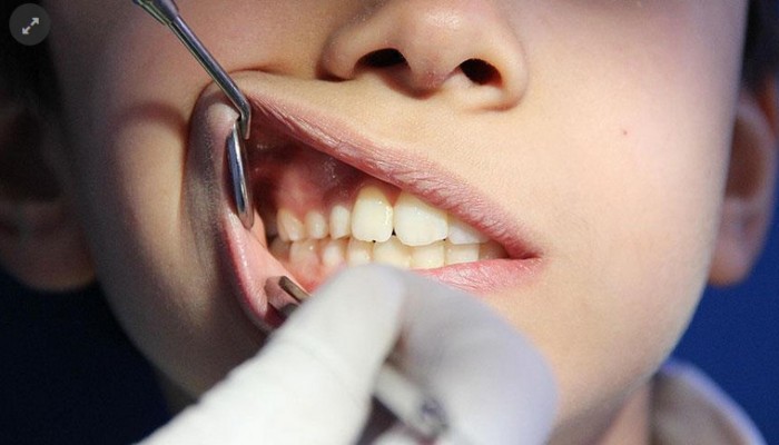 دراسة: أمراض اللثة تفاقم التدهور الإدراكي لمرضى الزهايمر