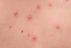 "نحس السيسي".. ظهور 21 حالة اشتباه بمرض الجدري بالمنوفية