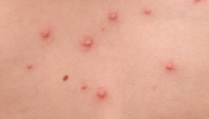 "نحس السيسي".. ظهور 21 حالة اشتباه بمرض الجدري بالمنوفية