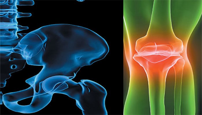 5 عوامل أساسية تسهم في علاج هشاشة العظام