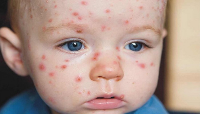 إصابة 23 تلميذ إبتدائى فى بنى سويف بمرض الجديرى المائى