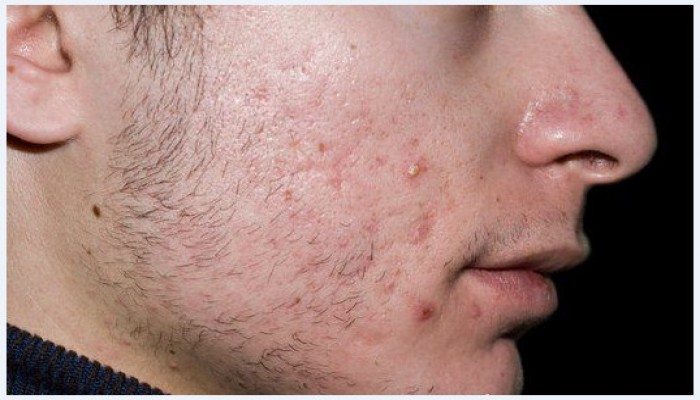 تعرف على 7 نصائح طبيعية للمساعدة في علاج "حب الشباب"