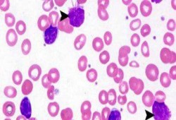 طرح أقراص جديد لعلاج سرطان الدم الليمفاوى المزمن بنسبة شفاء 80%