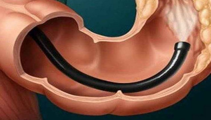 3 وصفات طبيعية لتنظيف القولون ومحاربة الإمساك والحموضة