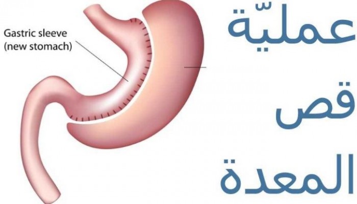 عملية قص المعدة وتصغيرها إلى حجم موزة تتصدر عمليات إنقاص الوزن