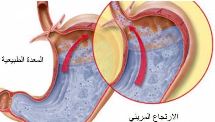 تعرف علي أسباب ارتجاع المريء وكيفية علاجه