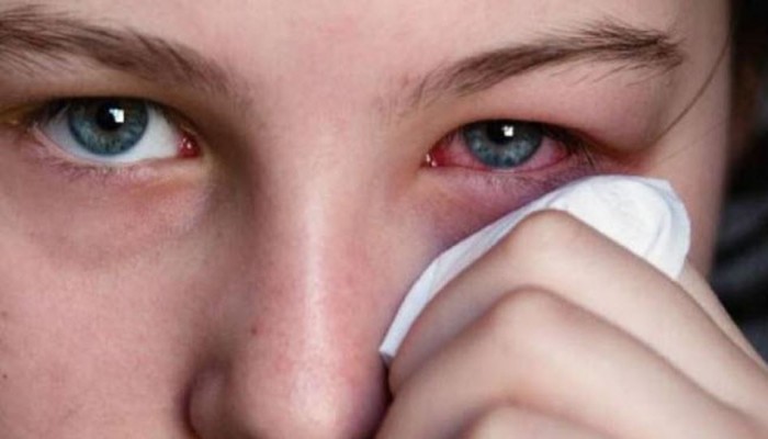 كيف تعالج حكة العينين بطرق بسيطة؟