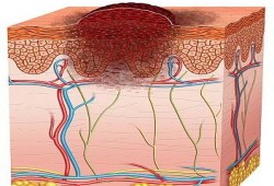 علماء أميركيون يتوصلون إلى علاج جديد لأخطر أنواع سرطان الجلد