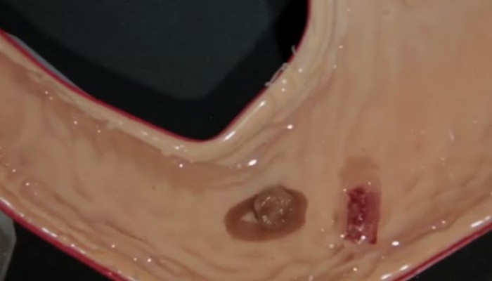 روبوت جديد يجري عمليات جراحية داخل المعدة "فيديو"