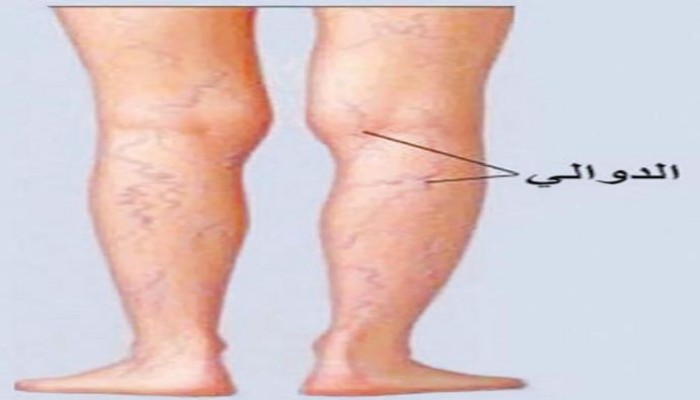 8 طرق للوقاية من دوالي الساقين
