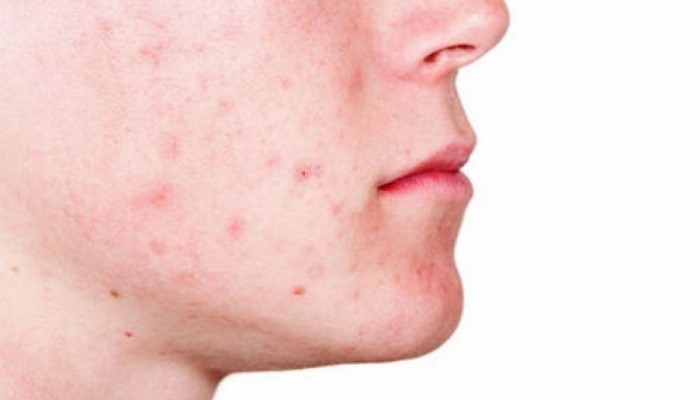 تعرف على 7 وصفات طبيعية لعلاج حب الشباب