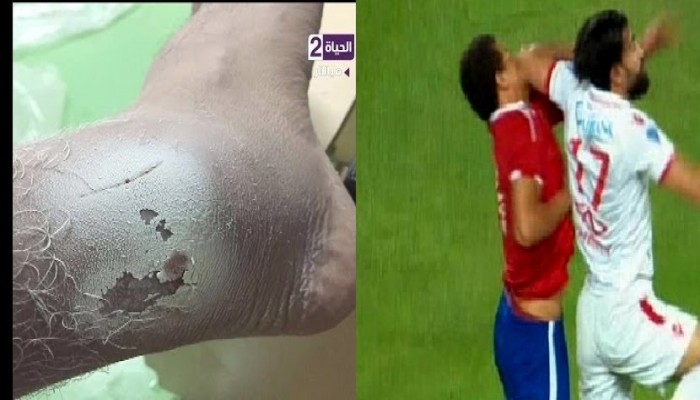 أكدوا تعمد إصابتهم .. لاعبي الأهلي يرفضون الصلح مع لاعبي الزمالك قبل معسكر المنتخب