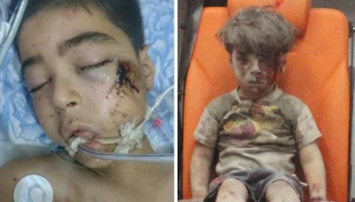 وفاة شقيق "عمران" طفل حلب