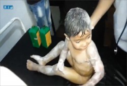 قنابل النظام الحارقة تشوه طفلا في حي الوعر بحمص