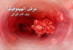 كارثة.. فشل السيسي يهدد 20 ألف مريض بـ"الهيموفيليا" ببتر أطرافهم