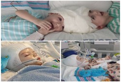 فصل توأمين ملتصقي الرأس بعد 20 ساعة بغرفة العمليات