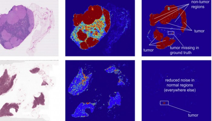جوجل تساعد الأطباء على تشخيص مرض السرطان