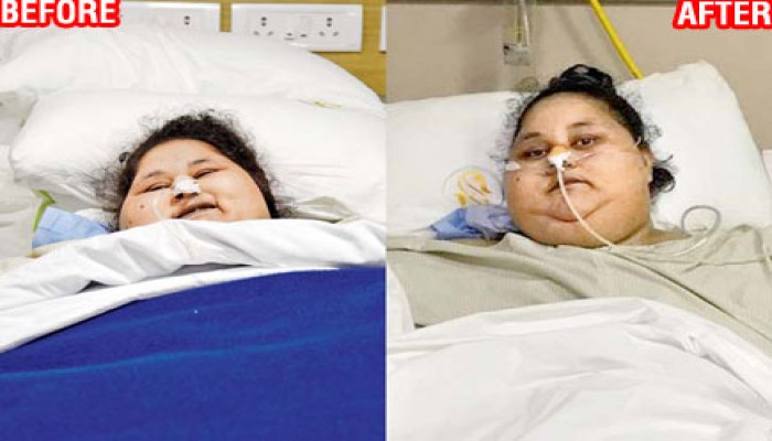 الأطباء الهنود : لا علاج لـ"إيمان عبدالعاطي"