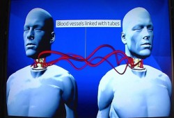 تحديد موعد أول جراحة لزراعة رأس في العالم