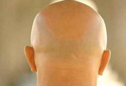 علماء يكتشفون علاجاً للصلع والشيب