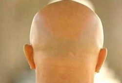 علماء يكتشفون علاجاً للصلع والشيب