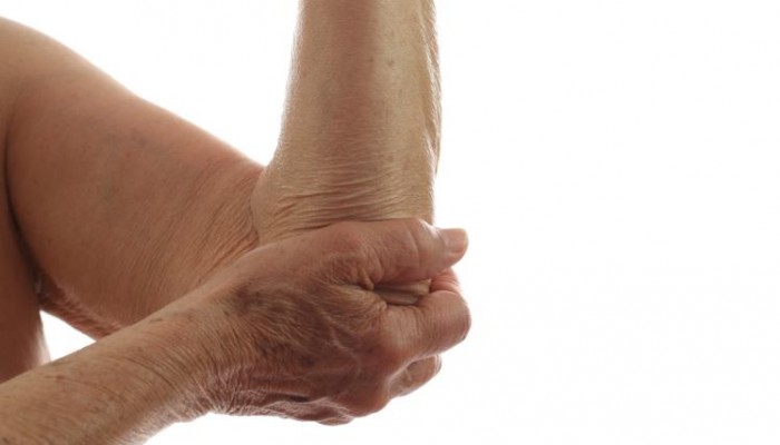 في يومه العالمي.. تعرف على مرض الذئبة الحمراء