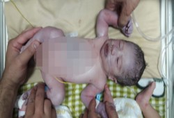 حماس: وقف عباس تحويلات مرضى غزة جرائم ضد الإنسانية