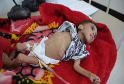 غارديان: الجوع والكوليرا يقتلان 80% من أطفال اليمن