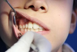 أمراض اللثة تزيد خطر إصابة النساء بالسرطان