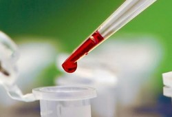 اختبار جديد يرصد انتشار الأورام السرطانية بقطرة دم