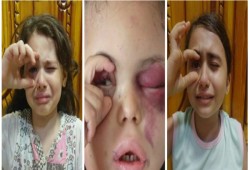 فقدت كل أسرتها.. العالم يتضامن مع إصابة طفلة يمنية في غارة سعودية