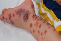 الطب الوقائي يتابع المتعافين من حمى الضنك في قنا