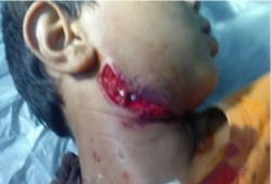 إفريقي يعض طفلا في القاهرة الجديدة.. مخدر "فلاكا" حوله إلى "زومبي"