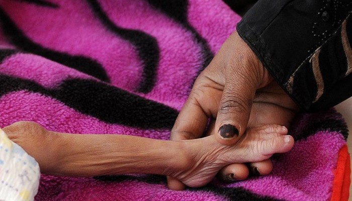 يونسيف: سوء التغذية بين أطفال الغوطة الشرقية يصل مستويات خطيرة