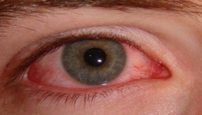 الشعور بجسم غريب في العين .. علام يدل؟