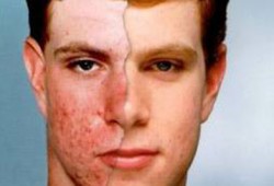 دراسة: حب الشباب يزيد فرص الإصابة بالاكتئاب الشديد