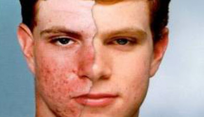 دراسة: حب الشباب يزيد فرص الإصابة بالاكتئاب الشديد