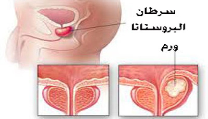 دواء جديد يمنح الأمل للرجال الذين يعانون من سرطان البروستات