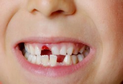 أعراض تنذر بنقص التمعدن بأسنان طفلك