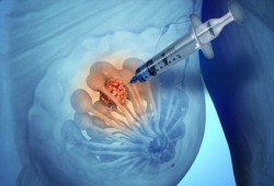 طريقة علاجية جديدة تستهدف أكثر أشكال سرطان الثدي فتكًا