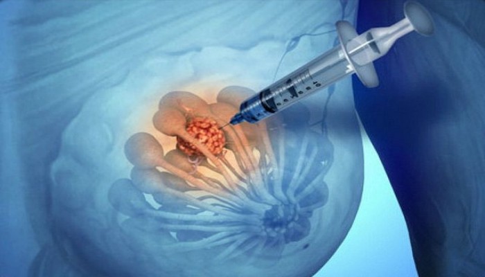 طريقة علاجية جديدة تستهدف أكثر أشكال سرطان الثدي فتكًا