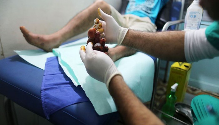 بعد منع طائراتها من نقل المصابين.. ماذا فعلت تركيا لجرحى غزة؟