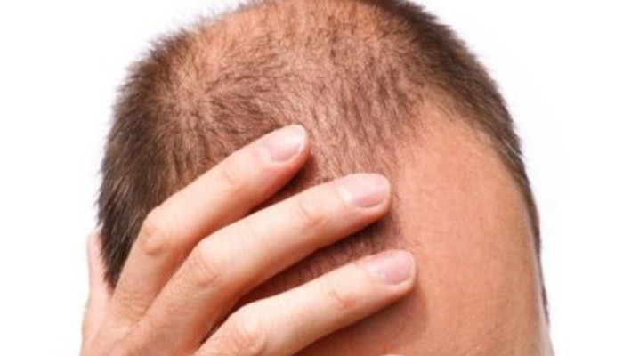 أطعمة تحميك من الصلع.. تعرّف إليها