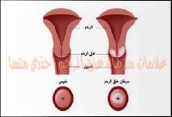إليكِ 8 علامات تدل على إصابتك بسرطان عنق الرحم لا تتجاهليها