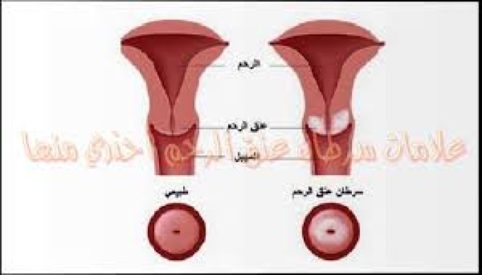 إليكِ 8 علامات تدل على إصابتك بسرطان عنق الرحم لا تتجاهليها