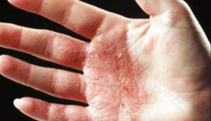 المشاكل الجلدية قد تكون نفسية